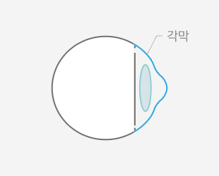 시력 저하된 안구 단면도 — STEP 01