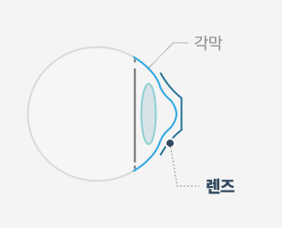 드림렌즈 착용 단면도 — STEP 02