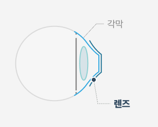 수면 중 각막 형태 교정 단면도 — STEP 03