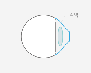 드림렌즈 제거 후 맑은 시야 — STEP 04