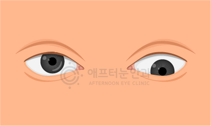 하사시 — 안구가 아래쪽으로 편위된 모습